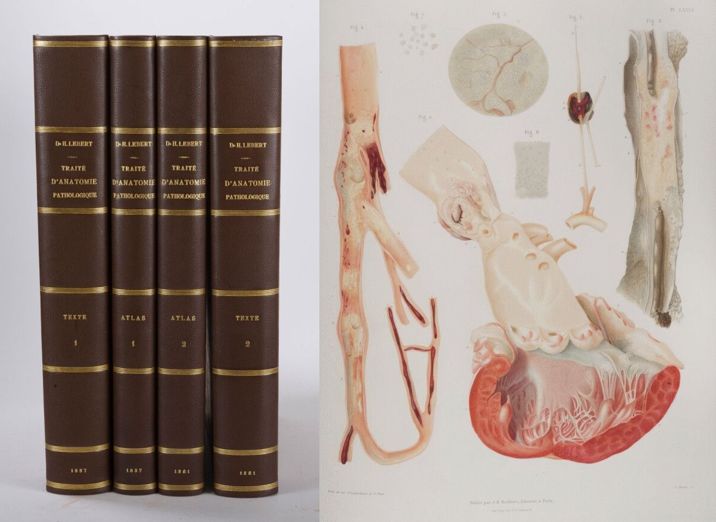 Traité d'Anatomie Pathologique générale et spéciale Hermann Lebert